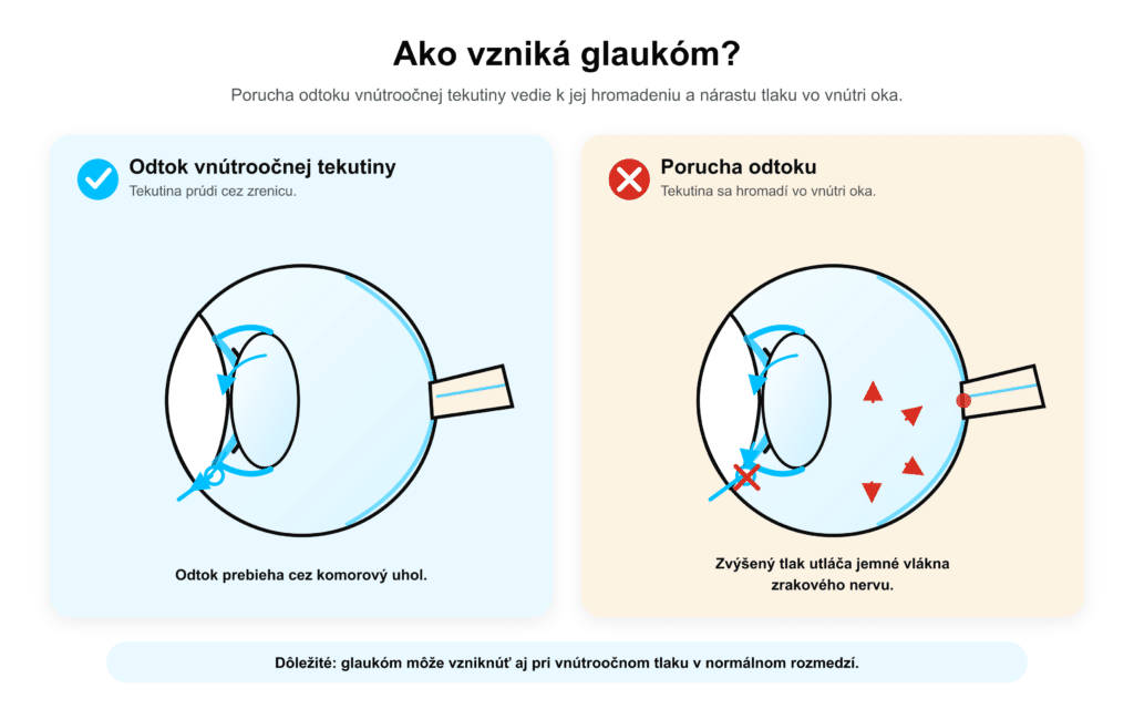schéma oka znázorňujúca tvorbu vnútroočnej tekutiny, jej prúdenie cez zrenicu, sťažený odtok v trámčine a poškodenie zrakového nervu