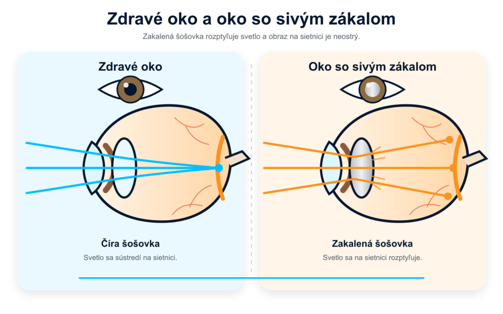 porovnanie prechodu svetla cez zdravú a zakalenú očnú šošovku