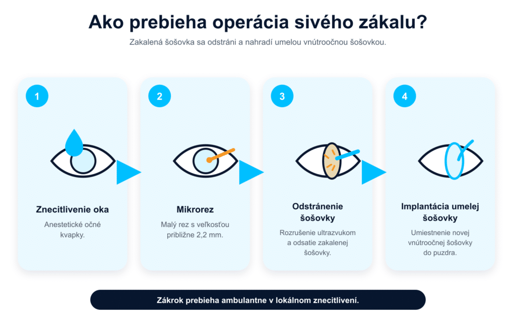 štyri kroky operácie sivého zákalu od znecitlivenia po vloženie šošovky